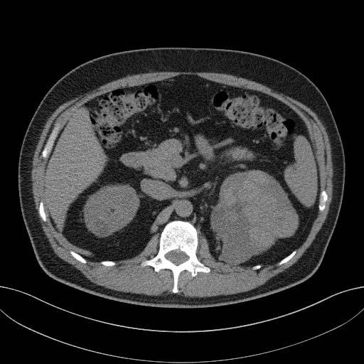 File:Clear cell renal cell carcinoma (Radiopaedia 61449-69393 Axial non-contrast 26).jpg