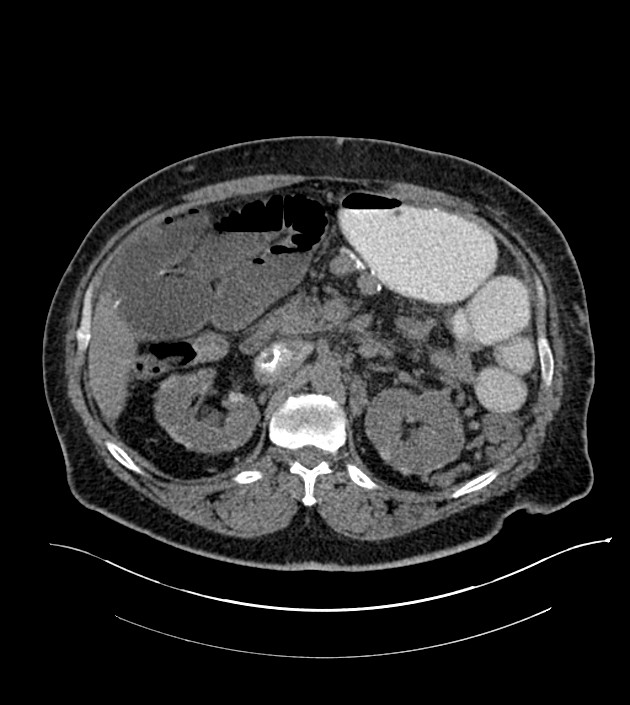 Closed-loop small bowel obstruction-internal hernia (Radiopaedia 78439-91096 Axial non-contrast 55).jpg