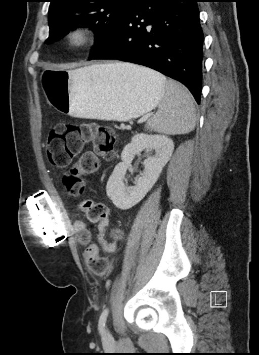 Closed loop obstruction - internal hernia into nephrectomy bed (Radiopaedia 59867-67320 C 20).jpg