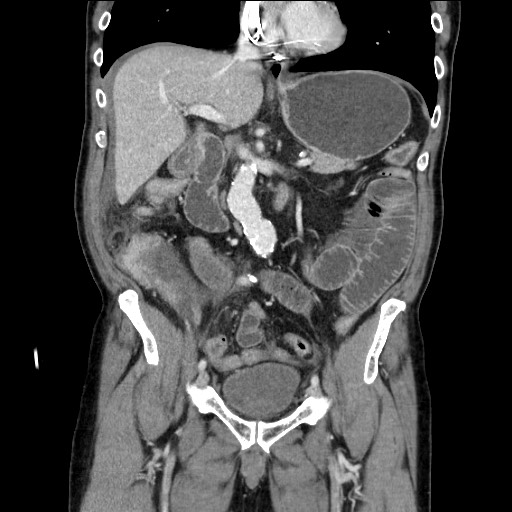 Closed loop obstruction due to adhesive band, resulting in small bowel ischemia and resection (Radiopaedia 83835-99023 E 61).jpg