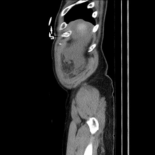 File:Closed loop obstruction due to adhesive band, resulting in small bowel ischemia and resection (Radiopaedia 83835-99023 F 29).jpg