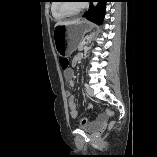Closed loop small bowel obstruction (Radiopaedia 65403-74451 C 61).jpg