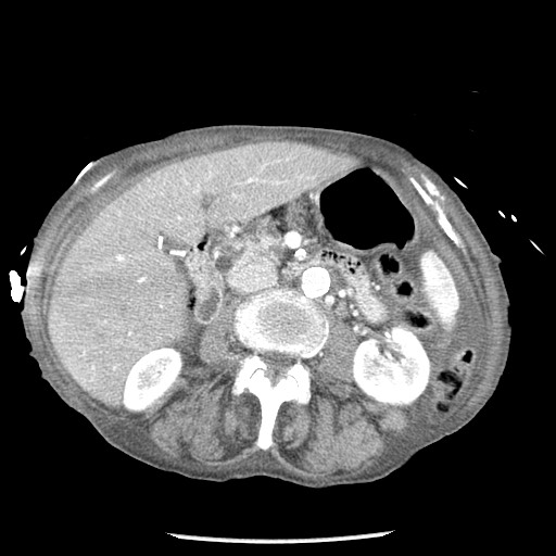 Closed loop small bowel obstruction - adhesions and infarct (Radiopaedia 85125-100678 B 41).jpg