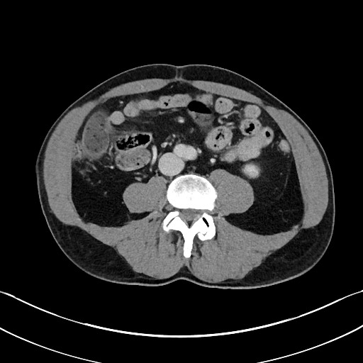 Closed loop small bowel obstruction - internal hernia (Radiopaedia 57806-64778 B 72).jpg