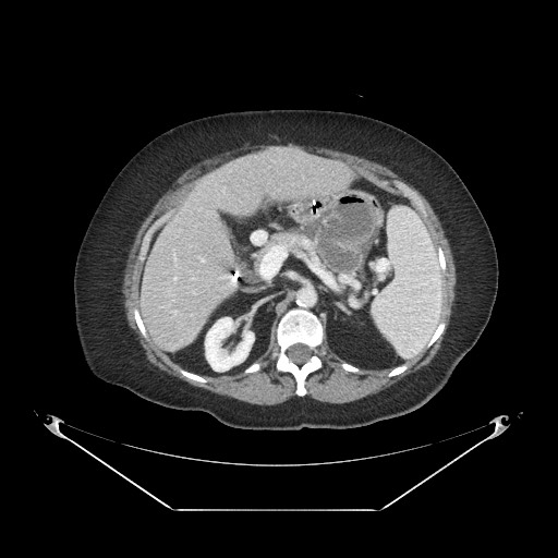 File:Closed loop small bowel obstruction - internal hernia (Radiopaedia 65402-74450 A 37).jpg