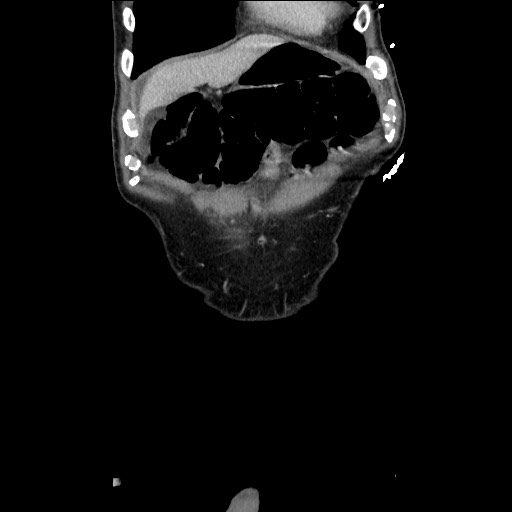 File:Closed loop small bowel obstruction - omental adhesion causing "internal hernia" (Radiopaedia 85129-100682 B 28).jpg