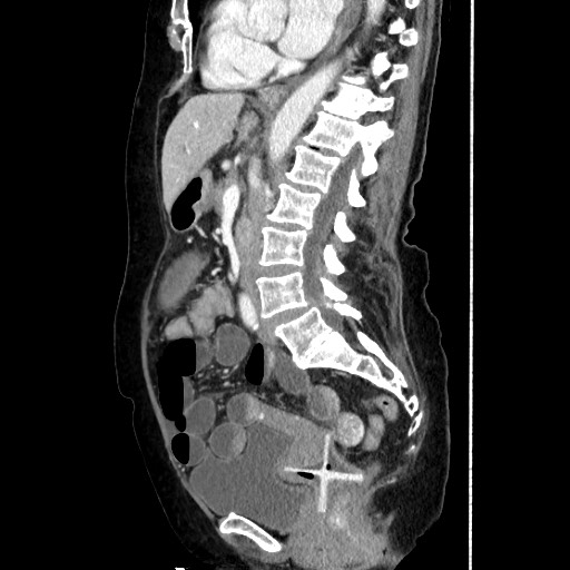 Closed loop small bowel obstruction due to adhesive band, with intramural hemorrhage and ischemia (Radiopaedia 83831-99017 D 105).jpg