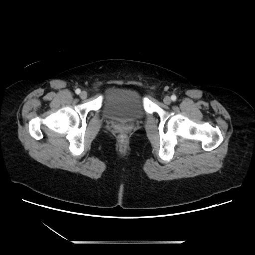 Closed loop small bowel obstruction due to adhesive bands - early and late images (Radiopaedia 83830-99014 A 154).jpg