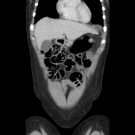 File:Closed loop small bowel obstruction due to trans-omental herniation (Radiopaedia 35593-37109 B 15).jpg