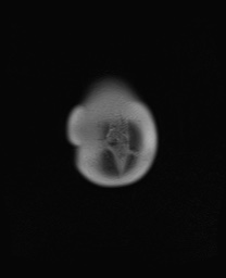 File:Closed loop small bowel obstruction in pregnancy (MRI) (Radiopaedia 87637-104031 Coronal T2 8).jpg