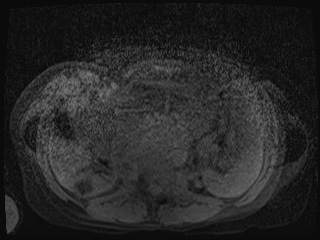 Closed loop small bowel obstruction in pregnancy (MRI) (Radiopaedia 87637-104031 F 1).jpg