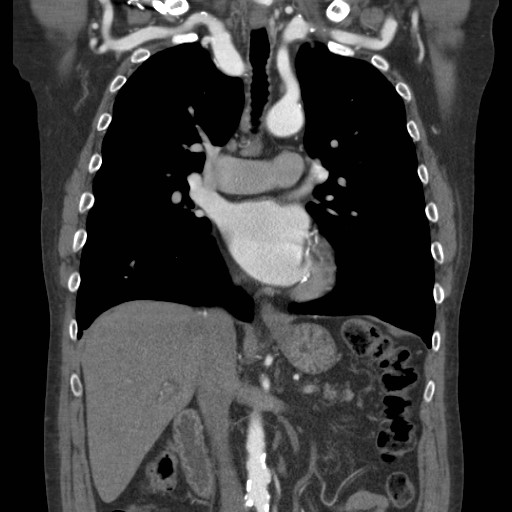 File:Coarctation of the aorta (Radiopaedia 17427-17116 A 47).jpg