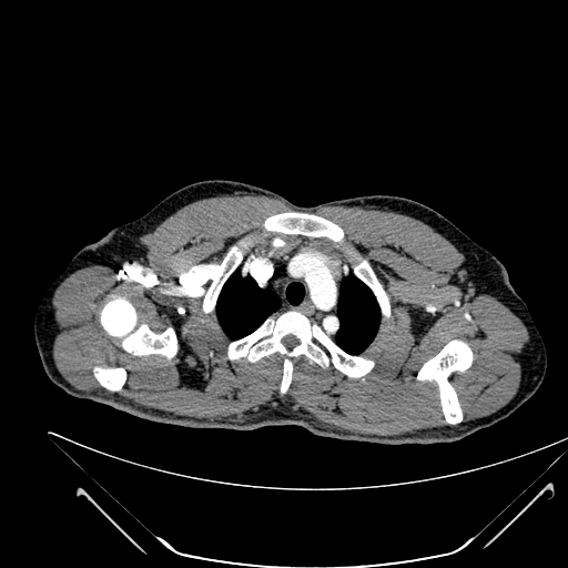 File:Coarctation of the aorta (Radiopaedia 49784-55050 B 10).jpg