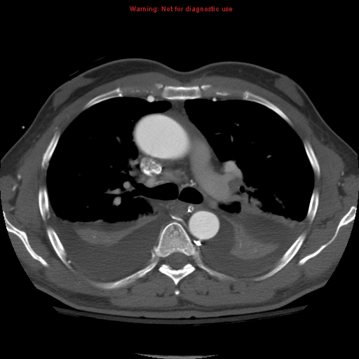File:Coarctation of the aorta (Radiopaedia 8681-9490 B 28).jpg
