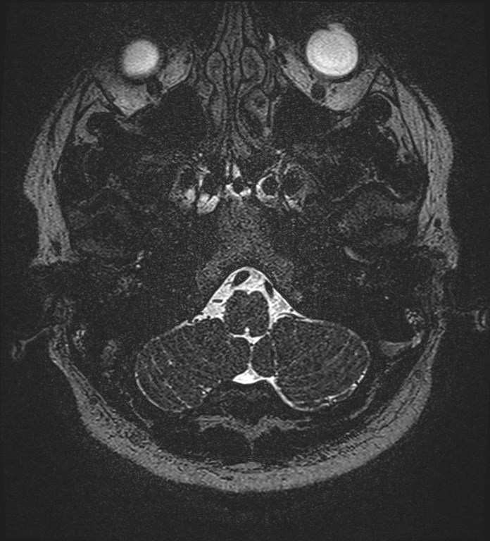 Cochlear incomplete partition type III associated with hypothalamic hamartoma (Radiopaedia 88756-105498 Axial T2 27).jpg