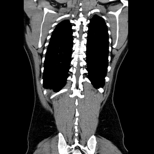 File:Codominant double aortic arch (Radiopaedia 56012-62637 B 40).jpg