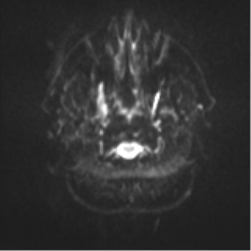 File:Colloid cyst (Radiopaedia 53164-59125 Axial DWI 1).png