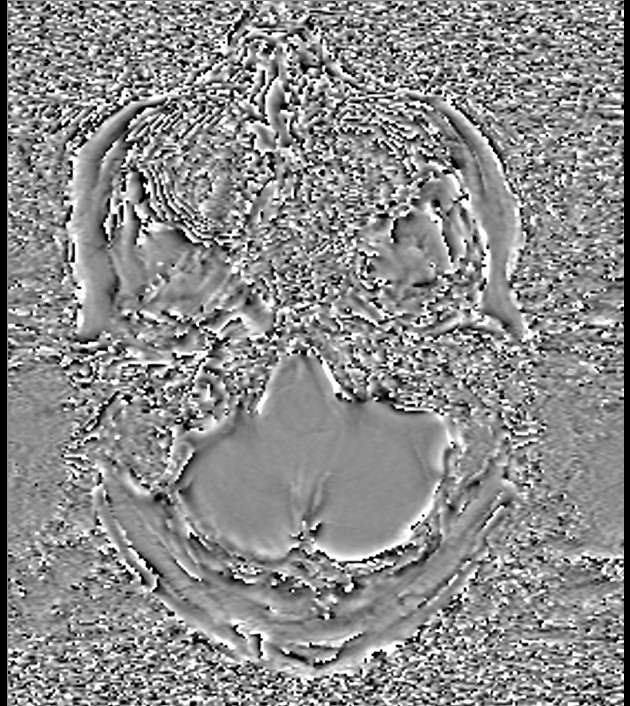 Colloid cyst (Radiopaedia 79336-92404 Axial SWI Phase 11).jpg
