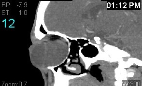 File:Colobomatous cyst (Radiopaedia 18034-17803 B 12).jpg