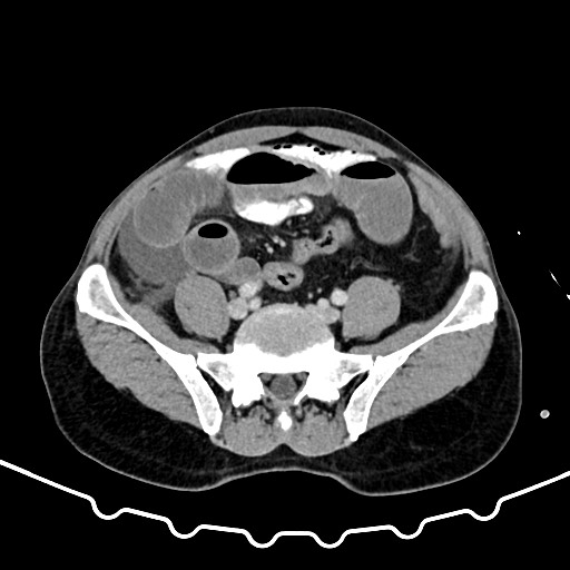 File:Colocolic intussusception due to large lipoma (Radiopaedia 68773-78482 A 135).jpg