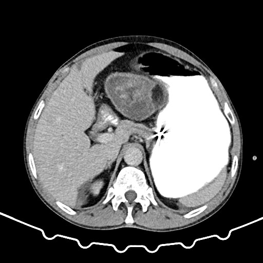 File:Colocolic intussusception due to large lipoma (Radiopaedia 68773-78482 A 39).jpg