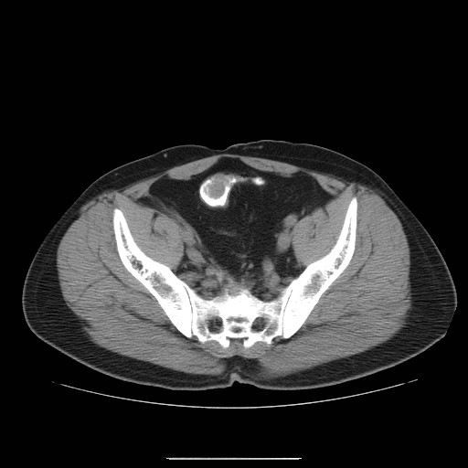 File:Colocutaneous fistula in Crohn's disease (Radiopaedia 29586-30093 D 30).jpg