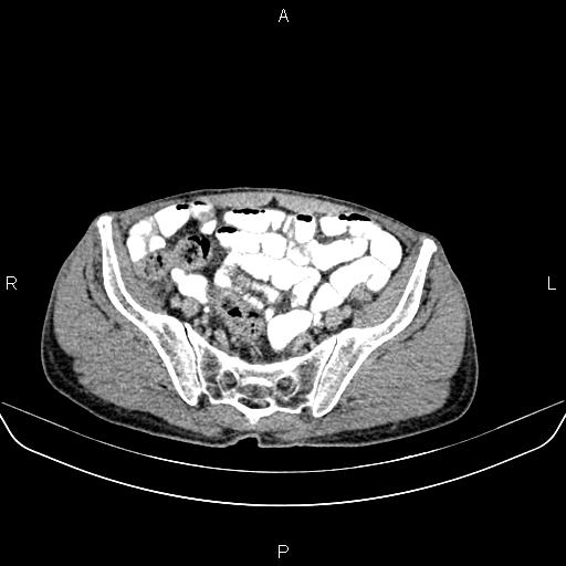 File:Colon adenocarcinoma - hepatic flexure (Radiopaedia 85635-101395 Axial C+ delayed 76).jpg