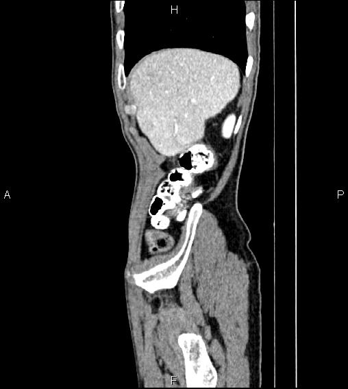 File:Colon adenocarcinoma - hepatic flexure (Radiopaedia 85635-101395 D 11).jpg