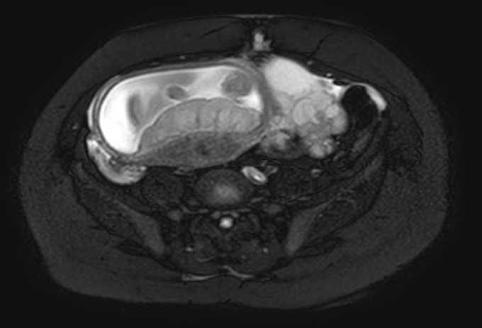 Colon adenocarcinoma with Krukenberg tumors, advanced pregnancy (Radiopaedia 67279-76645 Axial T2 SPAIR 28).jpg