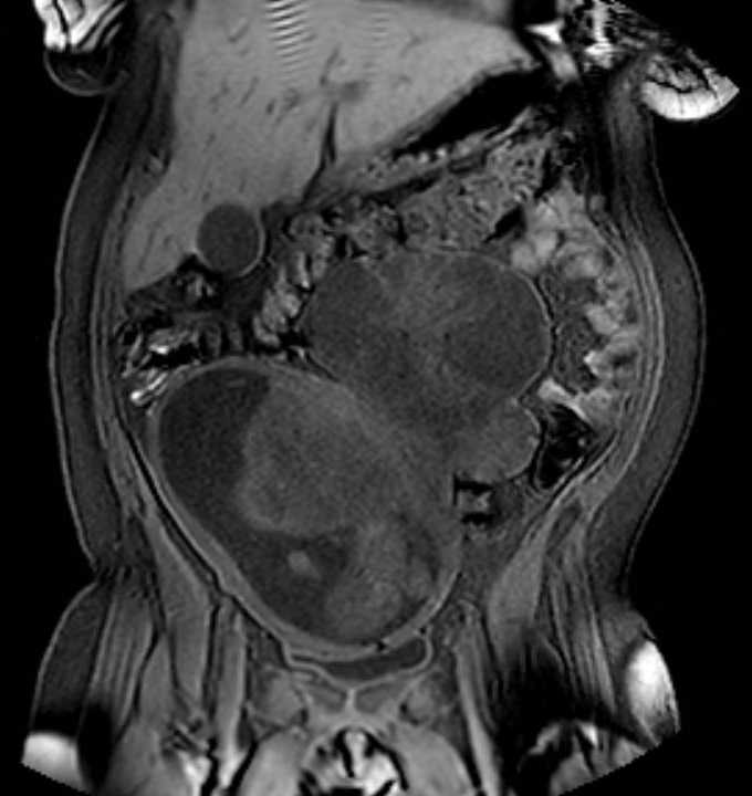 Colon adenocarcinoma with Krukenberg tumors, advanced pregnancy (Radiopaedia 67279-76645 E 28).jpg