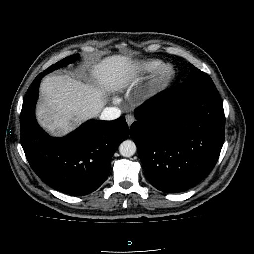 Colon adenocarcinoma with calcific liver metastasis (Radiopaedia 55745-62300 B 2).jpg