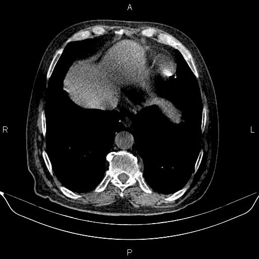 File:Colon cancer (Radiopaedia 90215-107432 Axial non-contrast 9).jpg