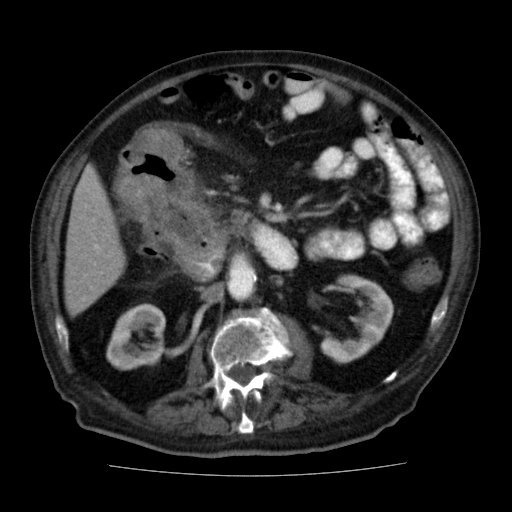 File:Colon cancer with duodenal invasion (Radiopaedia 16278-15958 A 27).jpg