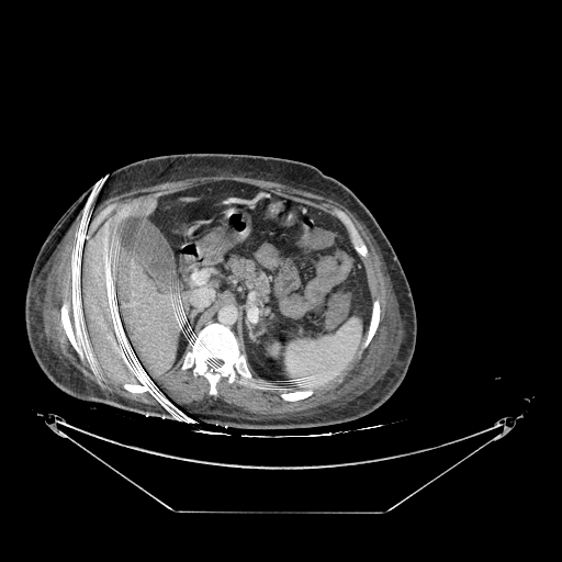 Colonic infarction after colostomy creation (Radiopaedia 81157-94797 A 22).jpg