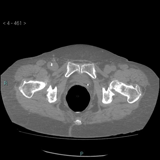 Colonic lipomas (Radiopaedia 49137-54244 Axial bone window 205).jpg