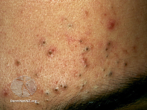 File:Comedonal acne (DermNet NZ acne-comed1).jpg
