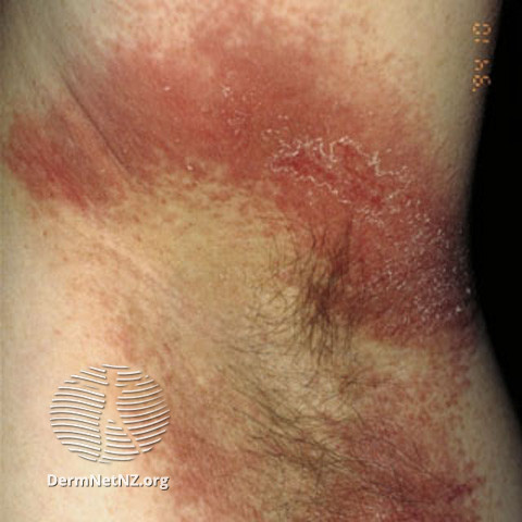 File:Intertrigo due to contact allergy to benzocaine (DermNet NZ dermatitis-s-2486).jpg