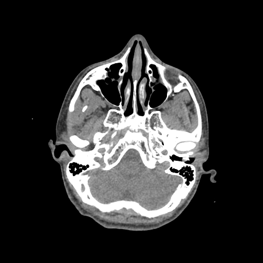 Nasal pyogenic granuloma (lobular capillary hemangioma) (Radiopaedia 85536-101244 Axial non-contrast 69).jpg
