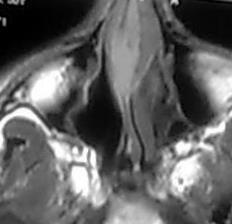 File:Nasal septum hematoma (Radiopaedia 6778-7968 B 1).jpg