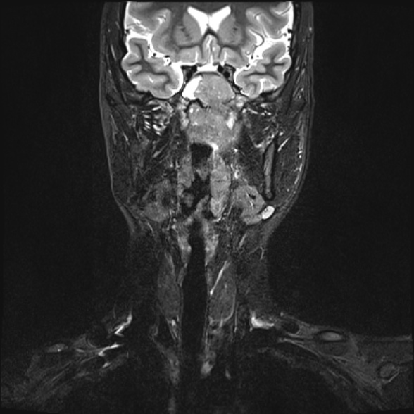 Nasopharyngeal carcinoma with skull base invasion (Radiopaedia 53415-59485 Coronal T2 fat sat 22).jpg