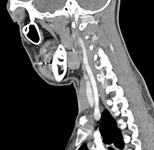 Nasopharyngeal carcinoma with skull base invasion (Radiopaedia 53415-59705 C 21).jpg