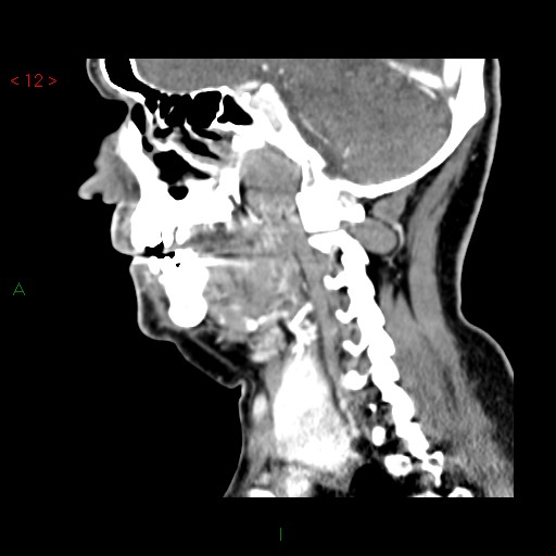 File:Nasopharyngeal lymphoma (Radiopaedia 54235-60432 B 23).jpg