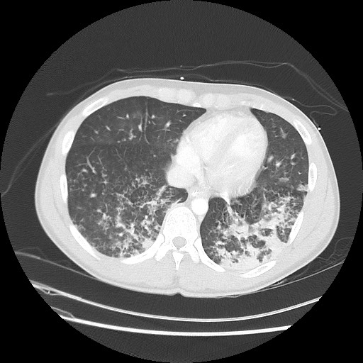 Near-drowning pulmonary edema (Radiopaedia 59457-66814 Axial lung window 43).jpg