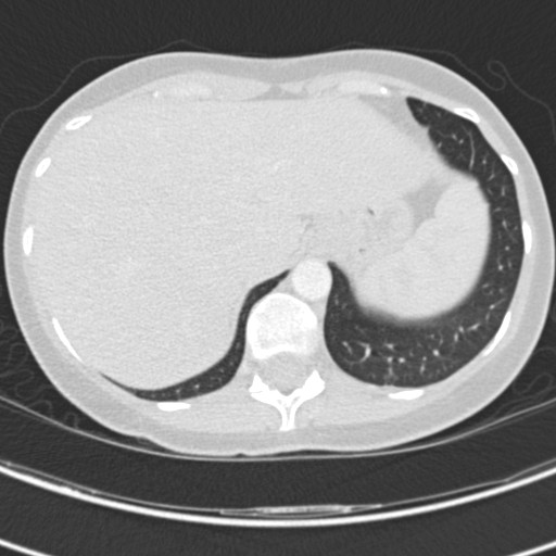 File:Necrobiotic pulmonary nodules - Crohn disease (Radiopaedia 20723-20631 Axial lung window 127).jpg