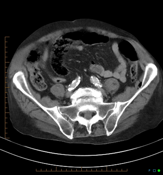 Necrotzing fasciitis due to a perforated adenocarcinoma of the splenic flexure (Radiopaedia 46930-51455 A 46).jpg