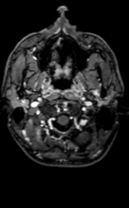 Neuro-Behçet disease (Radiopaedia 90112-107294 Axial T1 C+ 198).jpg