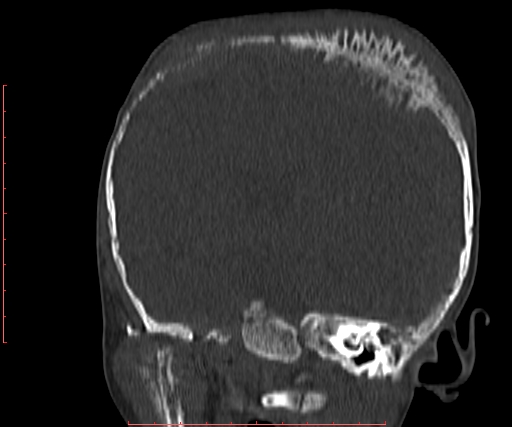 File:Neuroblastoma skull metastasis (Radiopaedia 56053-62683 Coronal bone window 20).jpg