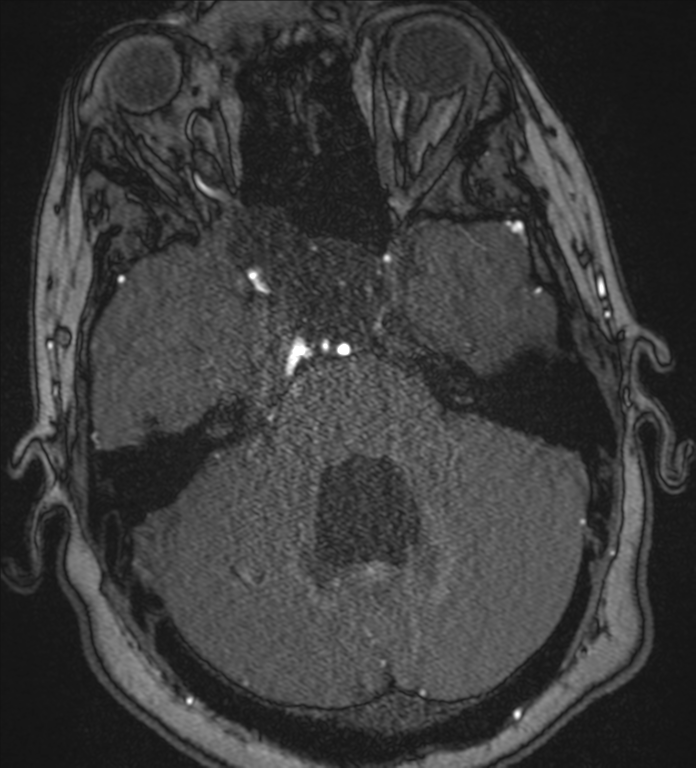 Neurofibromatosis type 1 - head and neck - CNS manifestations (Radiopaedia 49910-55188 Axial MRA 21).png