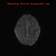 File:Neurofibromatosis type 1 with optic nerve glioma (Radiopaedia 16288-15965 Axial DWI 55).jpg