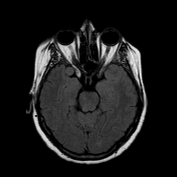 File:Neurofibromatosis type 2 (Radiopaedia 8713-9518 Axial FLAIR 16).jpg